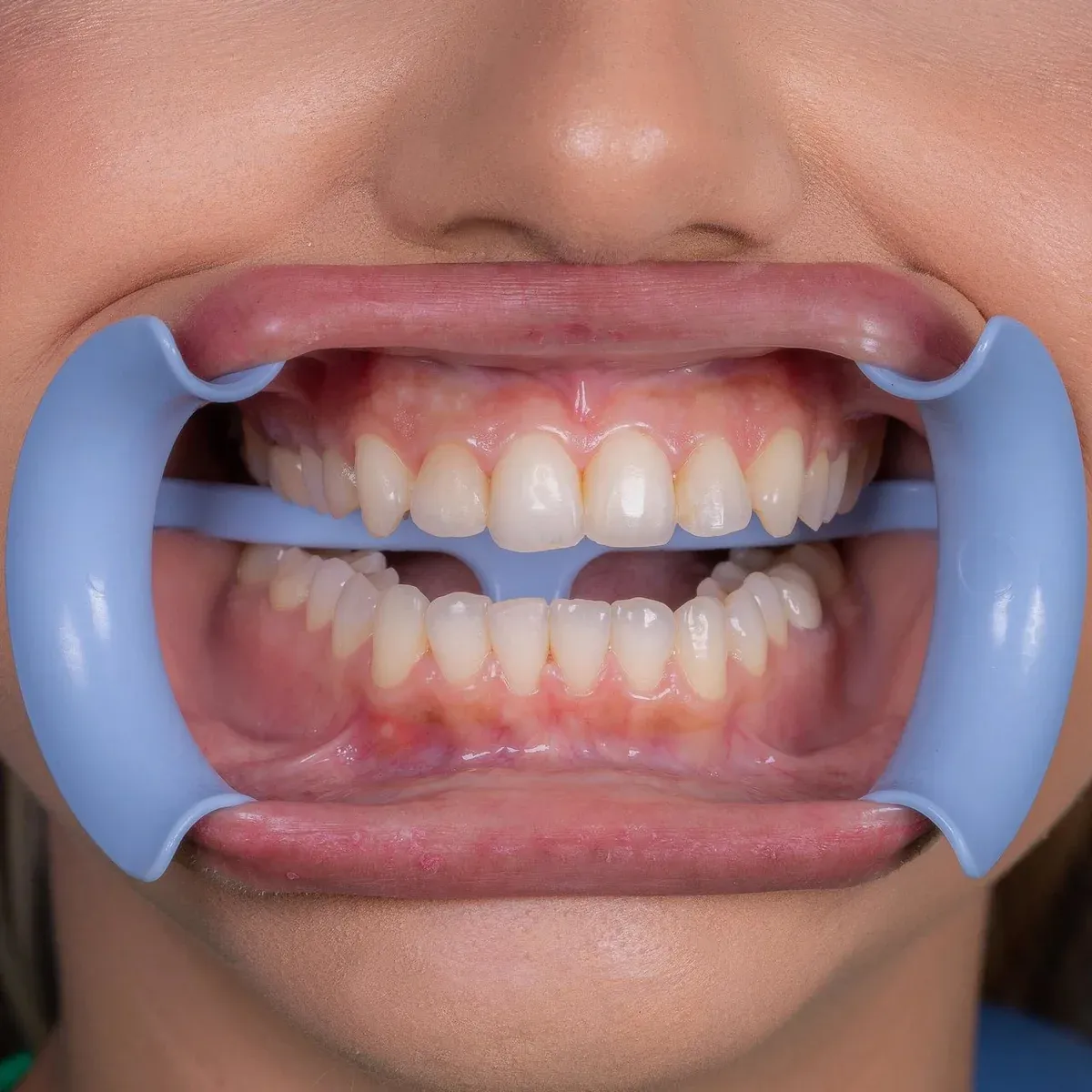 Lip Expand – Infantil, foto 5 de 5