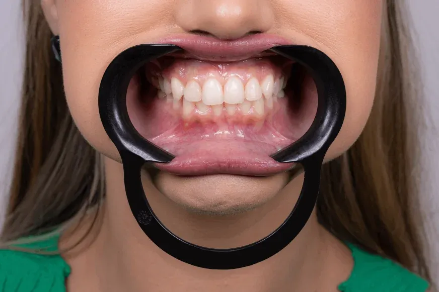 Pediatric Spandex Lip Retractor, photo 3 of 8
