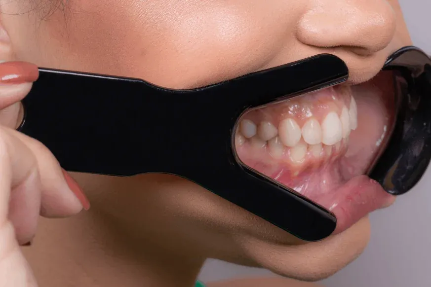 Afastador Labial V, foto 4 de 4